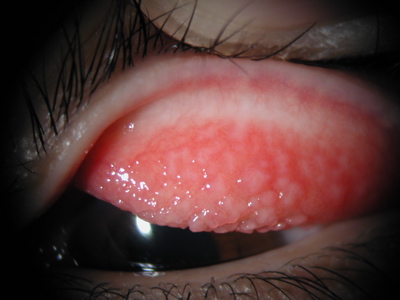 結膜炎 アレルギー コンタクト 性 目がかゆい!カラコンなどコンタクトレンズによる「アレルギー性結膜炎」の危険性と治療