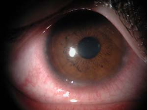 が する 目 ゴロゴロ 目がヒリヒリチクチク、ゴロゴロする違和感、原因は角膜のダメージ!? 角膜を修復して目の違和感を改善するには！
